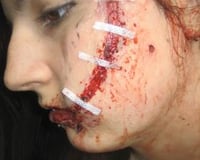 Laceration, Multiple Screwdriver Wounds