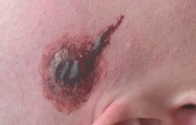 Bullet Wound