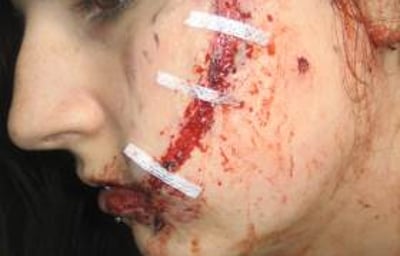 Laceration, Multiple Screwdriver Wounds